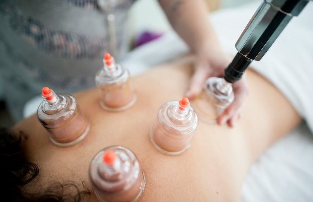 cupping for muscle pain